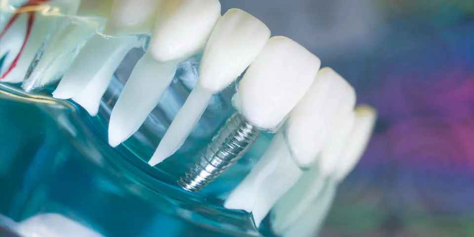 Restore Your Smile with Confidence