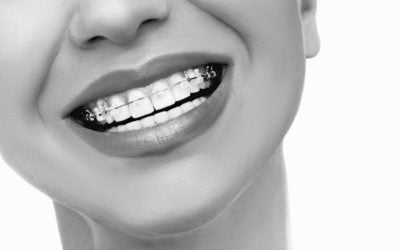 All you need to know about ceramic braces at Shields