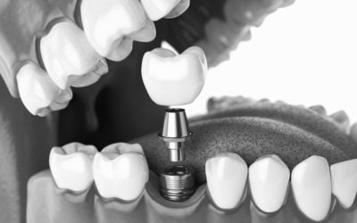Are Dental Implants Worth It? How to Decide if They’re Right for You