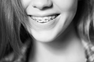 Types of orthodontic treatment at Shields Dental & Implant Clinic - Dental braces