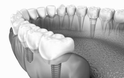 The process behind getting dental implants 