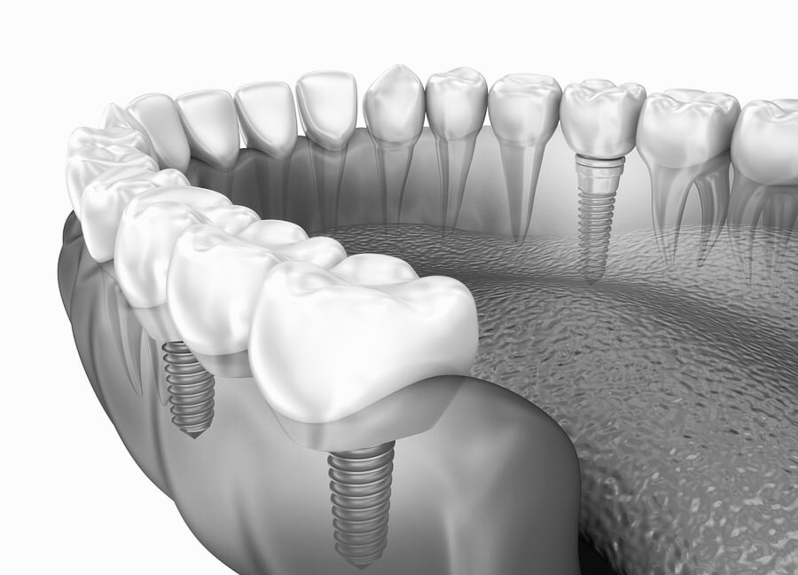 The process behind getting dental implants  - Dental implant