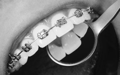 Looking after your metal braces 
