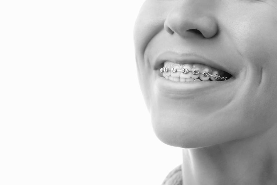 Teeth with dental braces. Orthodontic Treatment. Dental care Concept.