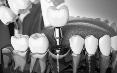 How dental implants can change your life and health