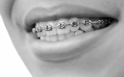 Orthodontic Treatment – Patient Review