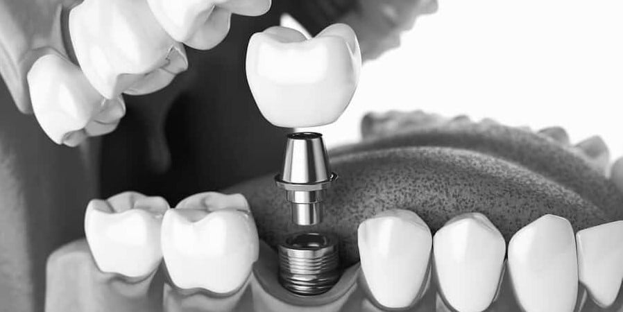 single dental implants