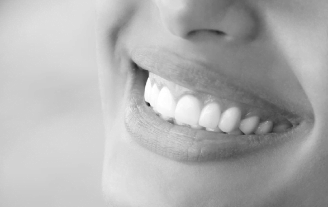 The Pros and Cons of Veneers: Are They Right for You?