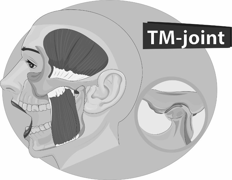 Locking down the Problem: 3 Facts About TMD - Temporomandibular disorder (TMD)