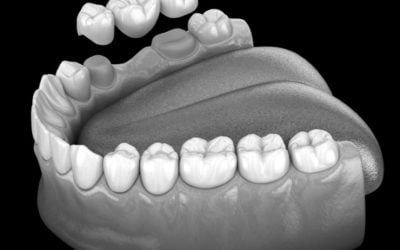 Types of Dental Bridges and How They Differ from Implants