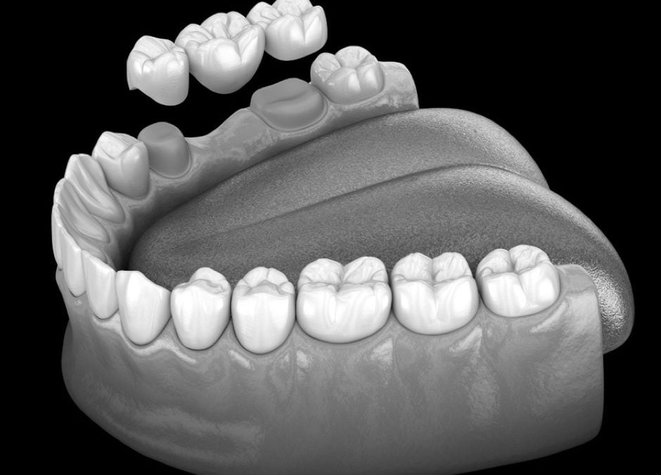 Types of Dental Bridges and How They Differ from Implants