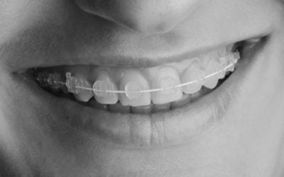 The Pros and Cons of Ceramic Braces