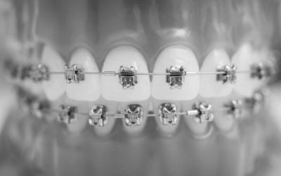 How to Clean Braces for Tip-Top Healthy Teeth