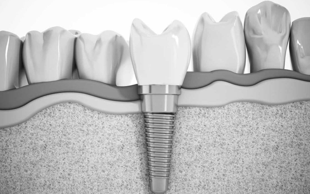 5 Tips to Saving Money on Dental Implants for Beginners