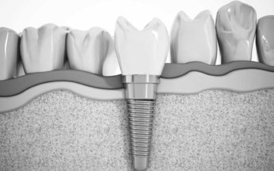 5 Tips to Saving Money on Dental Implants for Beginners