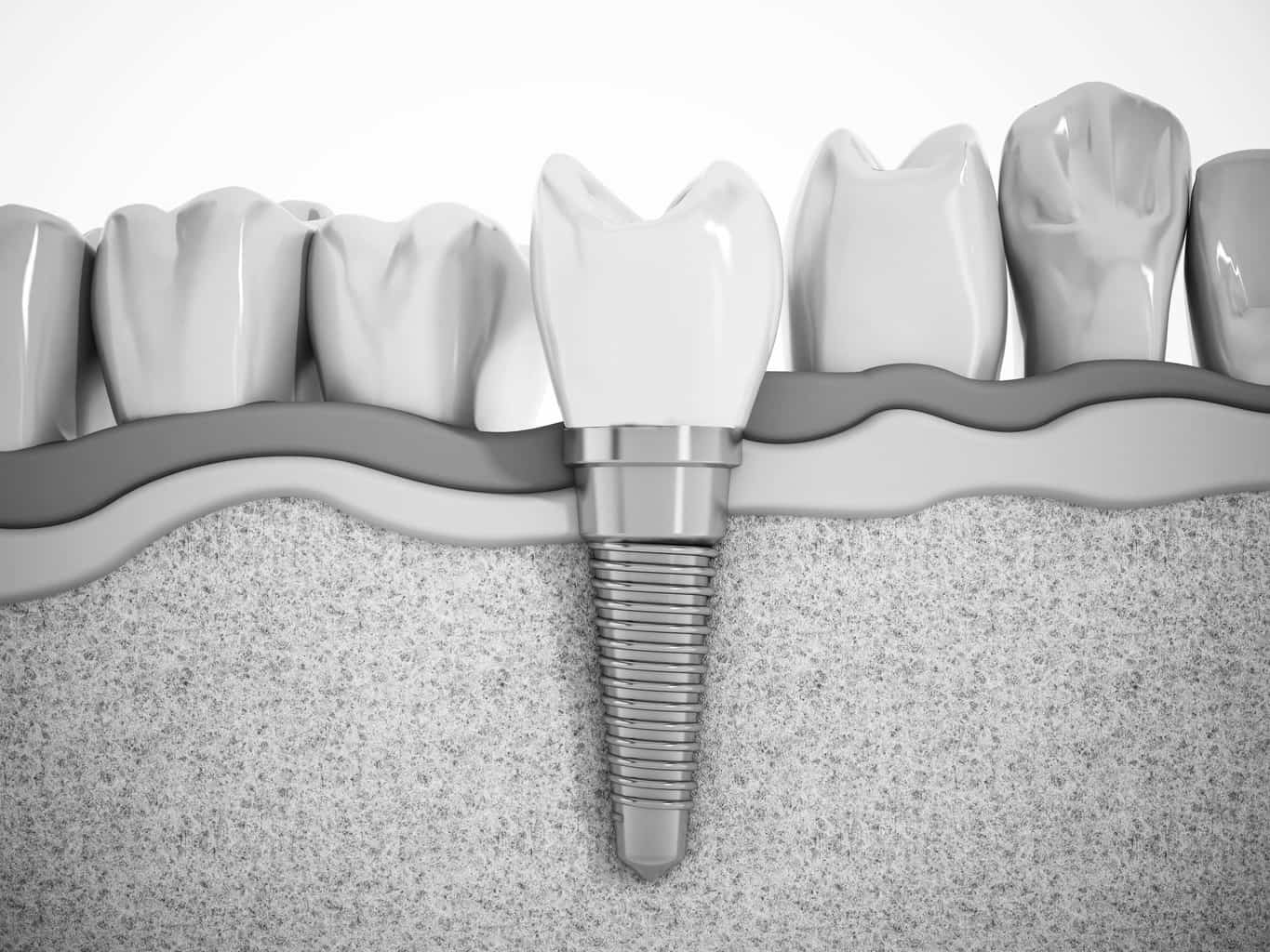 saving money on dental implants
