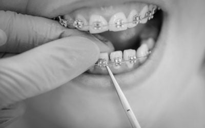 How To Avoid Common Side-Effects Of Dental Braces