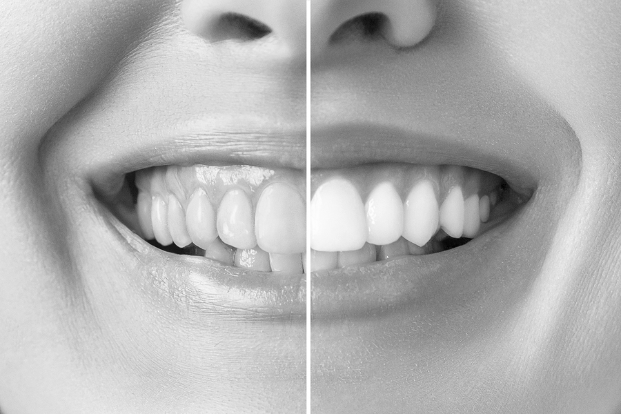 The Steps Taken During Teeth Whitening Treatment